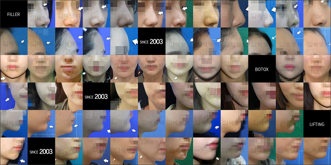 SINCE 2003 MI&MI, 시술후사진모음 부천실리프팅,상동역실리프팅