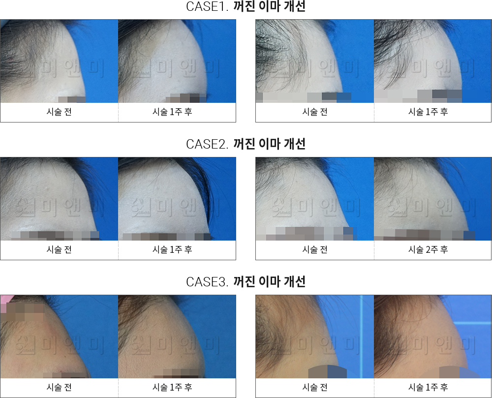 시술전후사진 이마필러 : 무턱개선 부천피부과-상동역피부과 아름다움을 위한 뷰티시크릿 부천피부과 미앤미