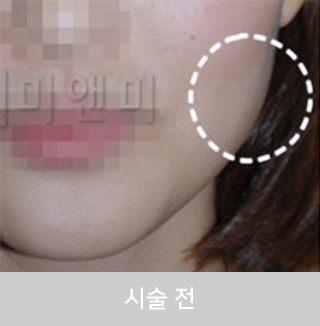 before_Img