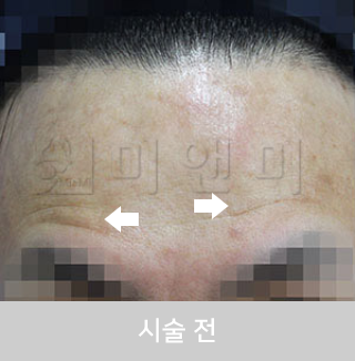 before_Img