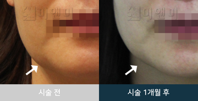 before_Img